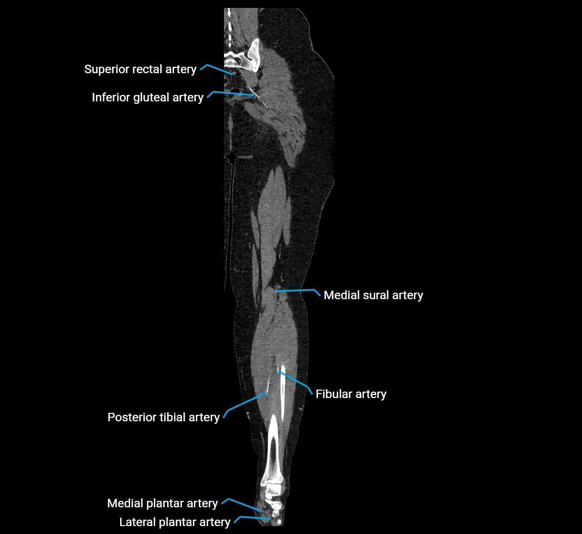 CTA lower limb coronal cross sectional anatomy labelled image _66 (2).webp